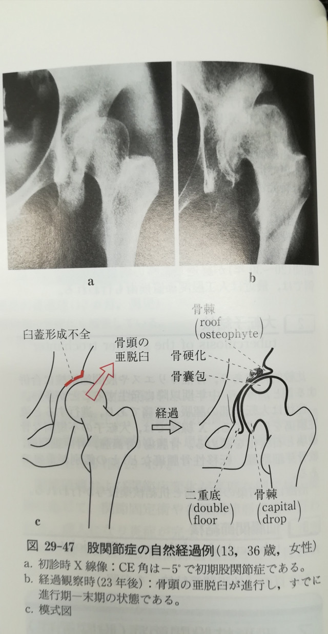 先天 性 臼 蓋 骨 形成 不全