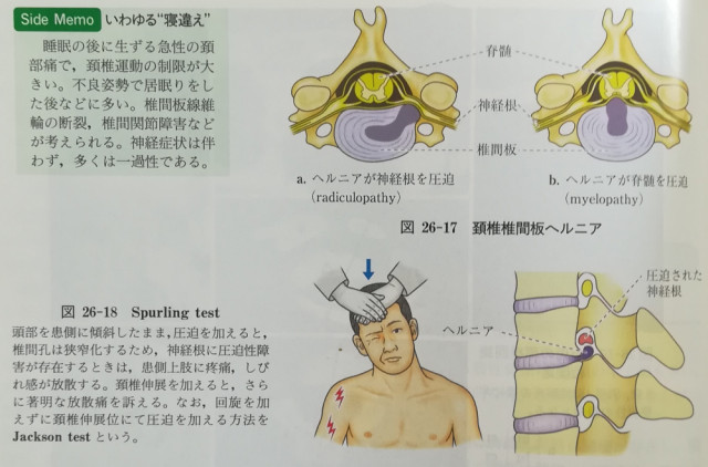 頸椎ヘルニアの徴候