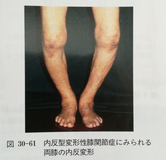変形性膝関節症によるO脚変形